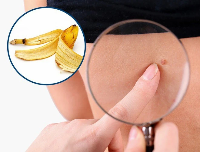 8 cách đơn giản và hiệu quả giúp chị em loại bỏ mụn thịt trên da.