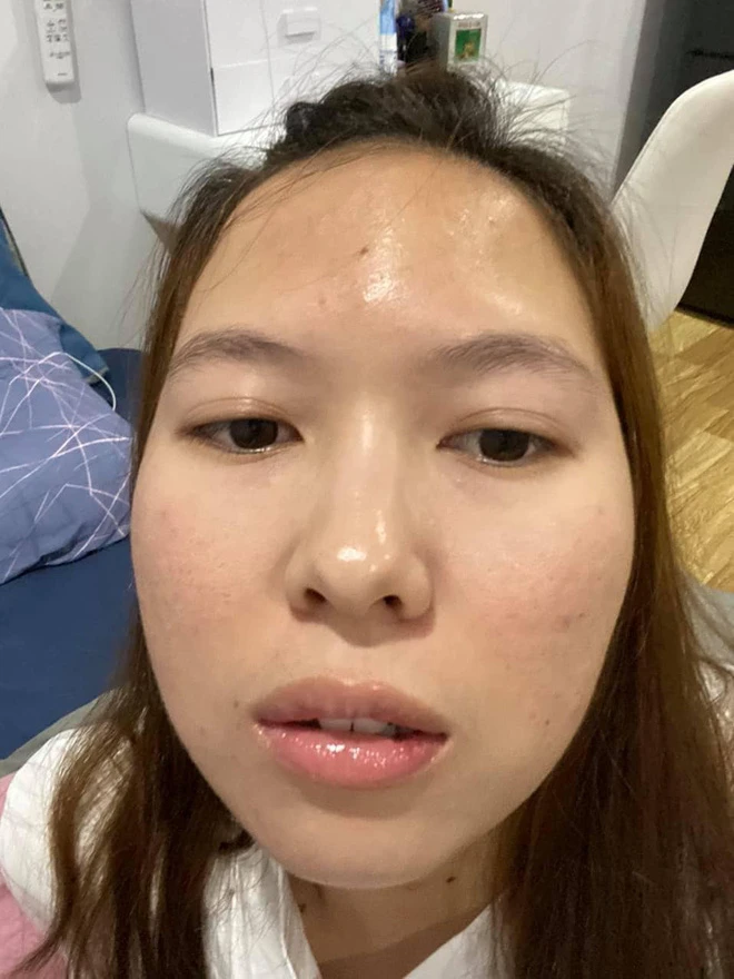 Từ làn da sần sùi nhiều mụn thâm, cô gái này đã "biến hóa" thành làn da khỏe đẹp chỉ với quy trình skincare 80% từ sản phẩm bình dân dễ tìm. Lỗ chân lông