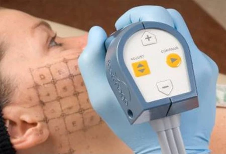 Thermage - Giải pháp trẻ hóa làn da không phẫu thuật Đi sâu
