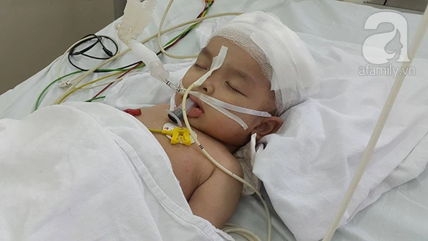 Bé 22 tháng tuổi bị chấn thương sọ não do ti vi rơi vào đầu. bệnh viện Việt Đức