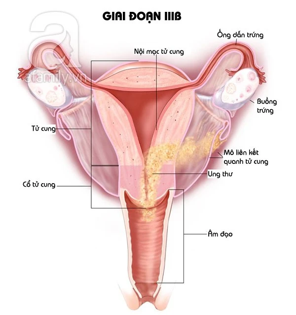 Khám Phá Các Giai Đoạn Của Ung Thư Nội Mạc Tử Cung Qua Hình Ảnh tim
