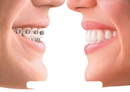 6 điều cần lưu ý khi niềng răng mà bạn không nên bỏ qua thay đổi