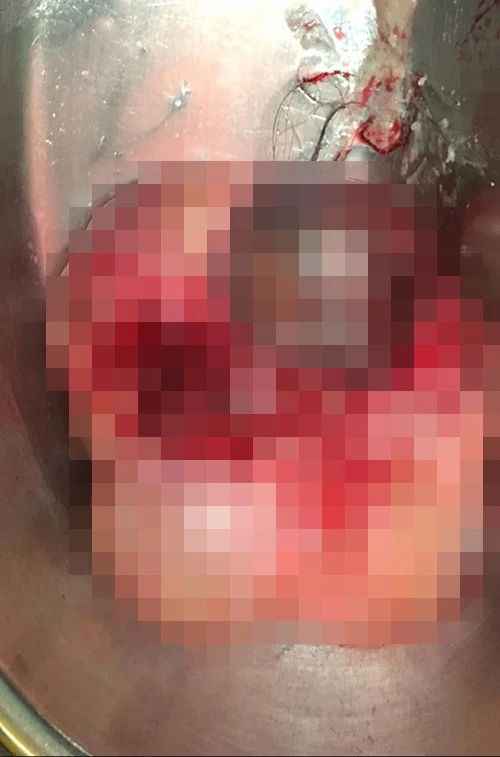 "Cô gái bất ngờ phát hiện u nang buồng trứng sau buổi massage, nguyên nhân liên quan đến chế độ ăn hàng ngày" thói quen ăn uống có hại sức khỏe