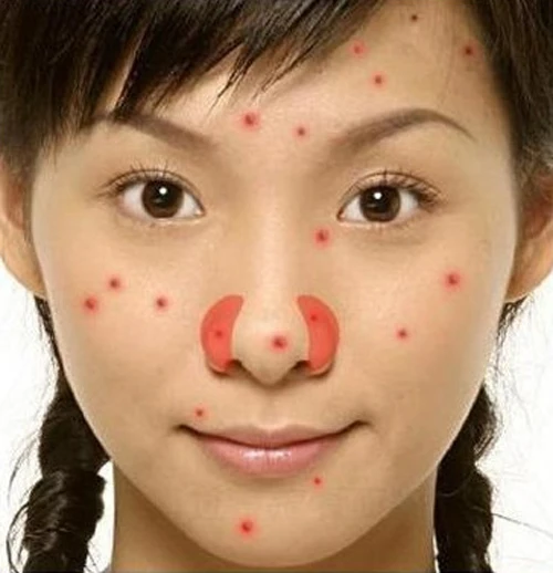 Chẩn đoán sức khỏe qua vị trí của mụn trứng cá trên cơ thể mụn trứng cá