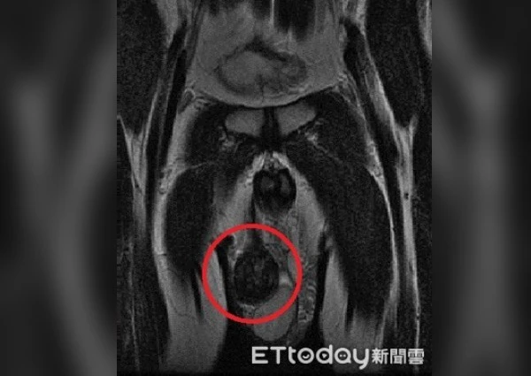 "Ngỡ ngàng khi phát hiện bạn trai có tới 3 tinh hoàn trong lúc âu yếm" khối u lạ