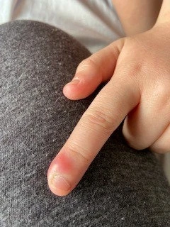 Mẹ lo lắng khi thấy con cắn móng tay, không ngờ cậu bé suýt mất mạng vì biến chứng của căn bệnh hiếm gặp ở trẻ em. bệnh tiểu đường loại 1