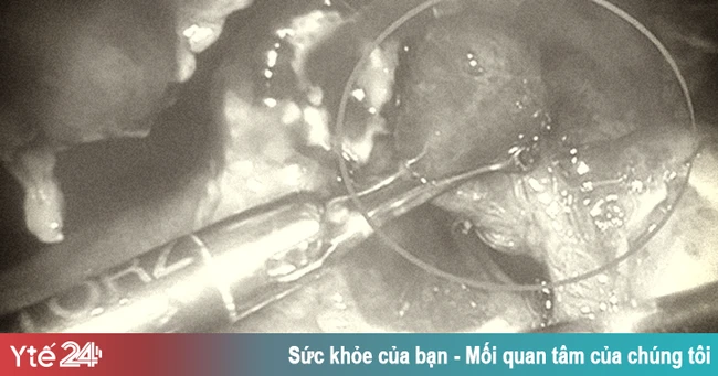 Cảnh báo sớm về viêm ruột thừa ở trẻ em