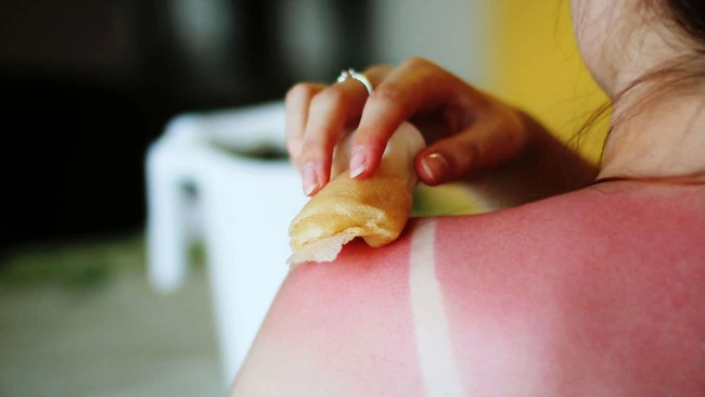 Cháy nắng cấp độ 3: Tác hại nghiêm trọng và cách phòng ngừa hiệu quả da cháy nắng