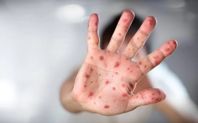 Chăm sóc trẻ mắc tay chân miệng tại nhà: 5 điều quan trọng giúp bé nhanh hồi phục. chăm sóc trẻ bị tay chân miệng tại nhà